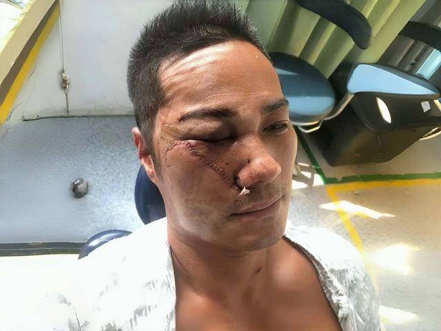 好惨！香港知名男星遭陌生人乱刀砍伤缝百针后首揭点错相悲剧